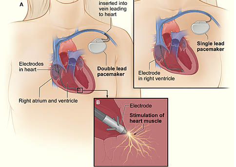 pacemaker image