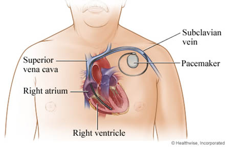 pacemaker image