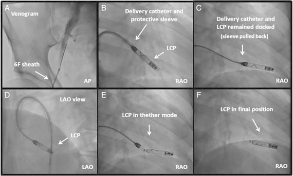 pacemaker image