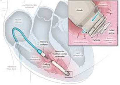 pacemaker image